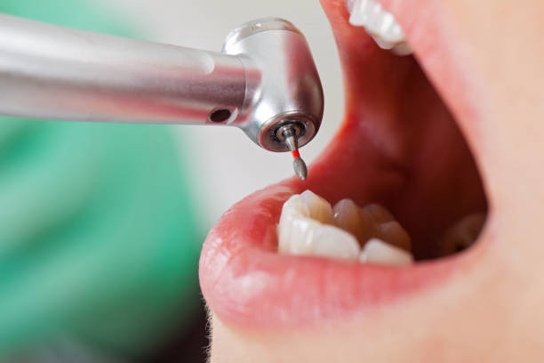Best Emergency Broken Tooth Repair in Oakland, CA